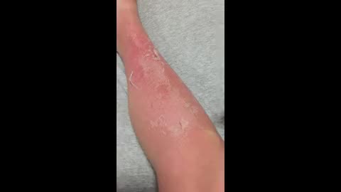 Skin Peeling from Sunburn #asmr - It is what it is